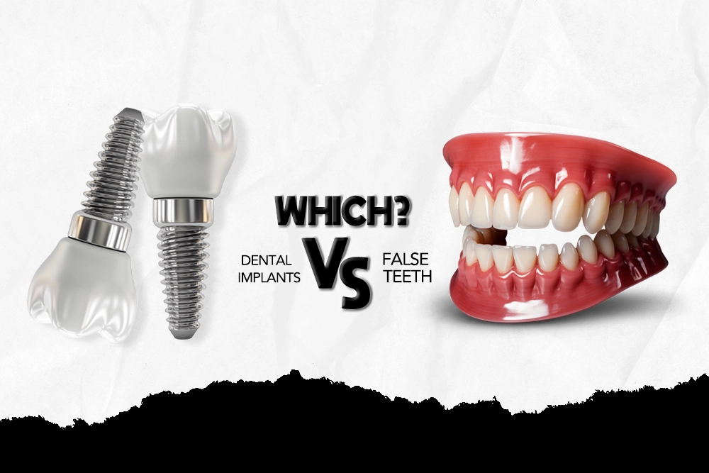 Dental Implants Vs False Teeth