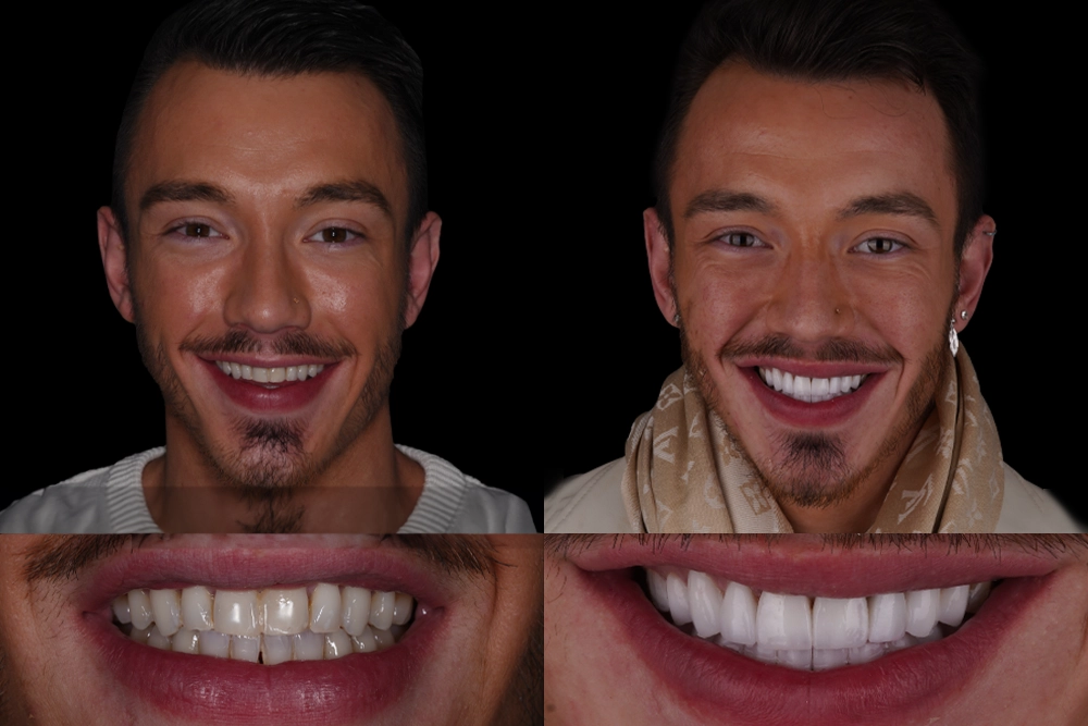 Dental Veneer Treatment Before After Images