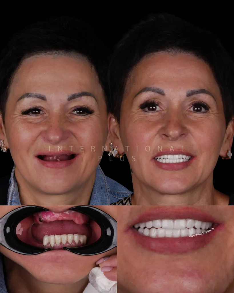 Full Mouth Dental Implant Treatment in Turkey