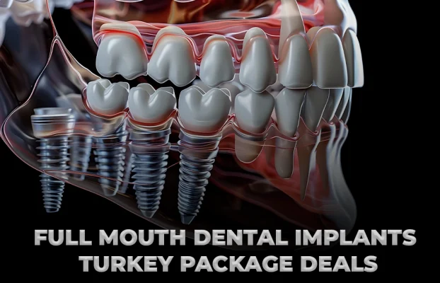 Full Mouth Dental Implants Turkey Package Deals