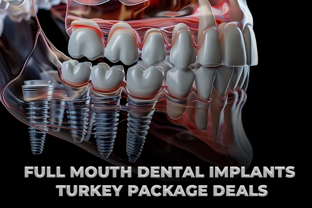 Full Mouth Dental Implants Turkey Package Deals