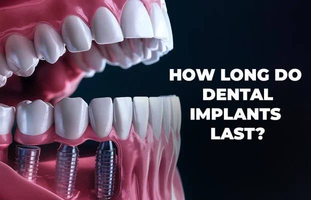 How Long Do Dental Implants Last