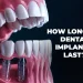 How Long Do Dental Implants Last