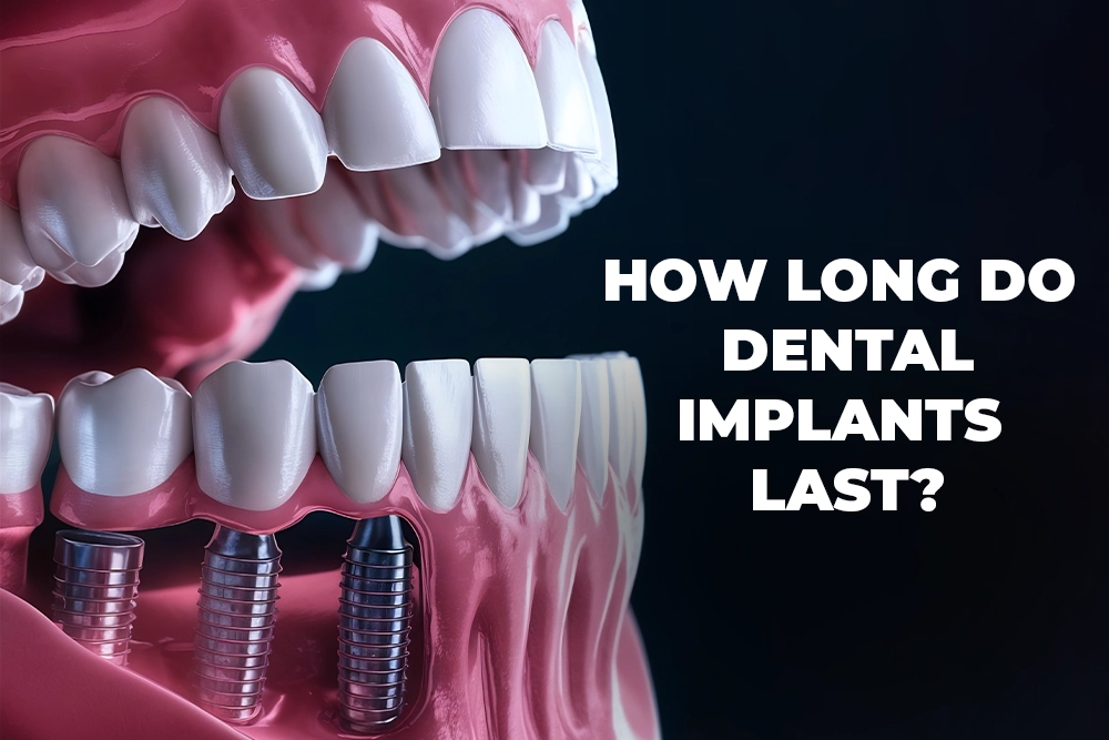 How Long Do Dental Implants Last