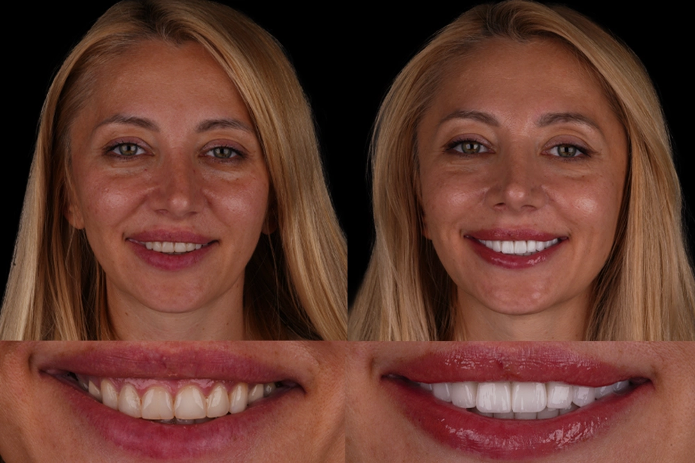 How Much Are Emax Veneers in Turkey?