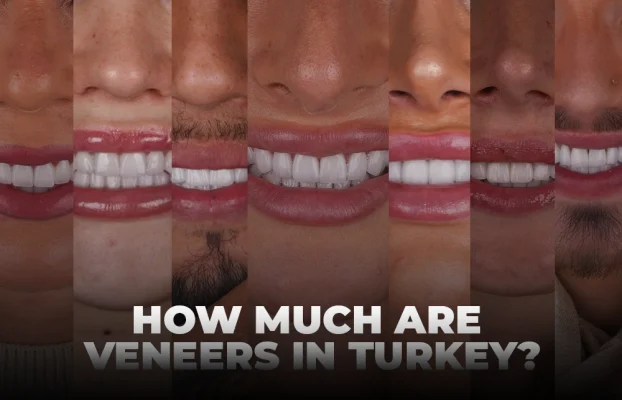 How Much Are Dental Veneers In Turkey?