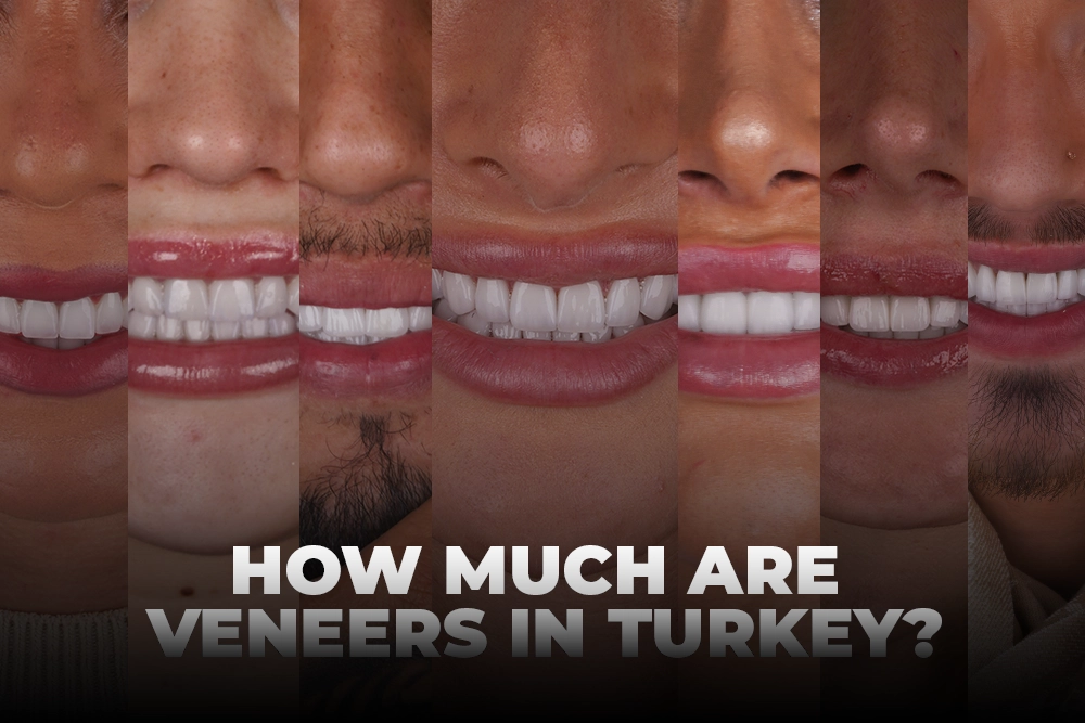 How Much Are Dental Veneers In Turkey?