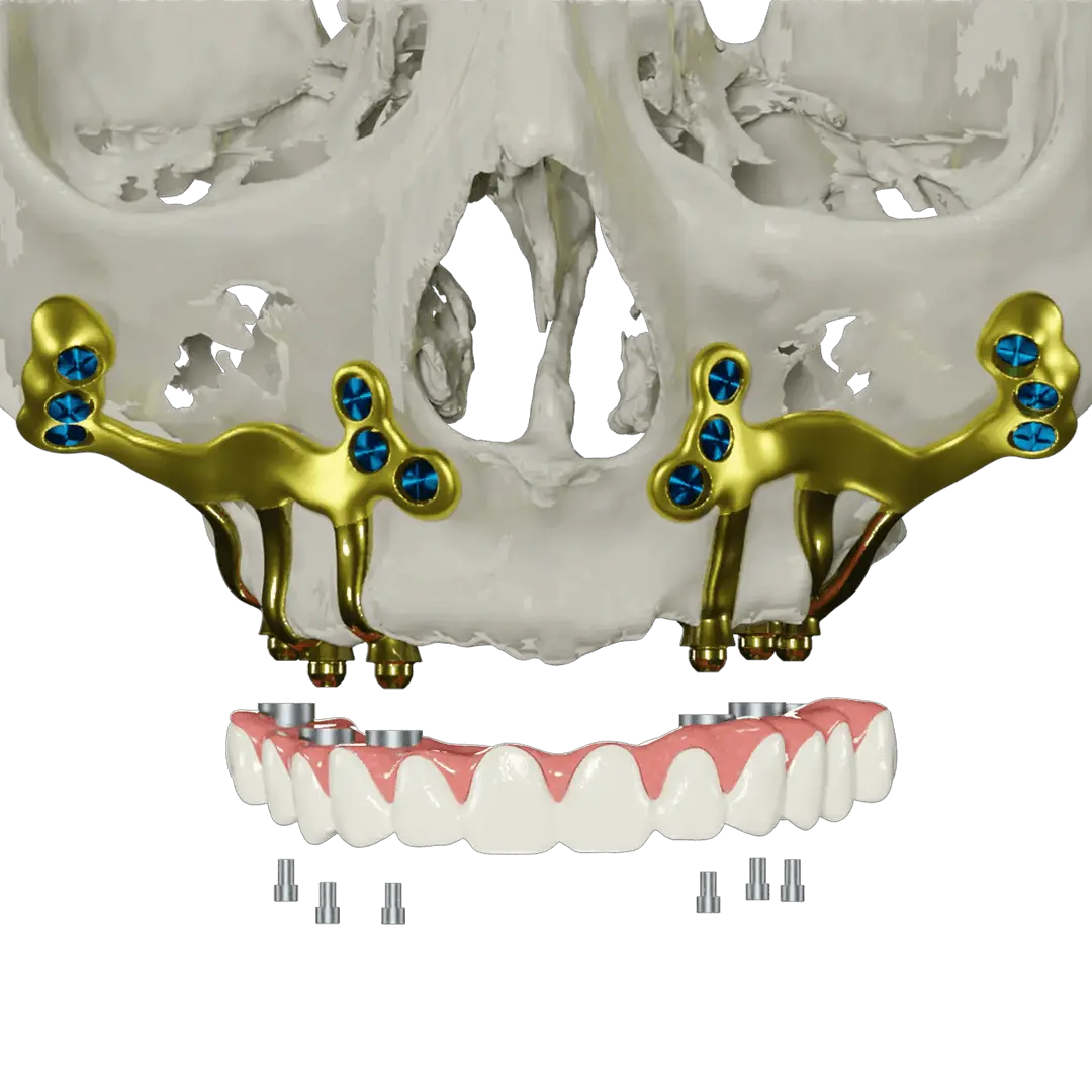 Advantages of Custom Dental Implants