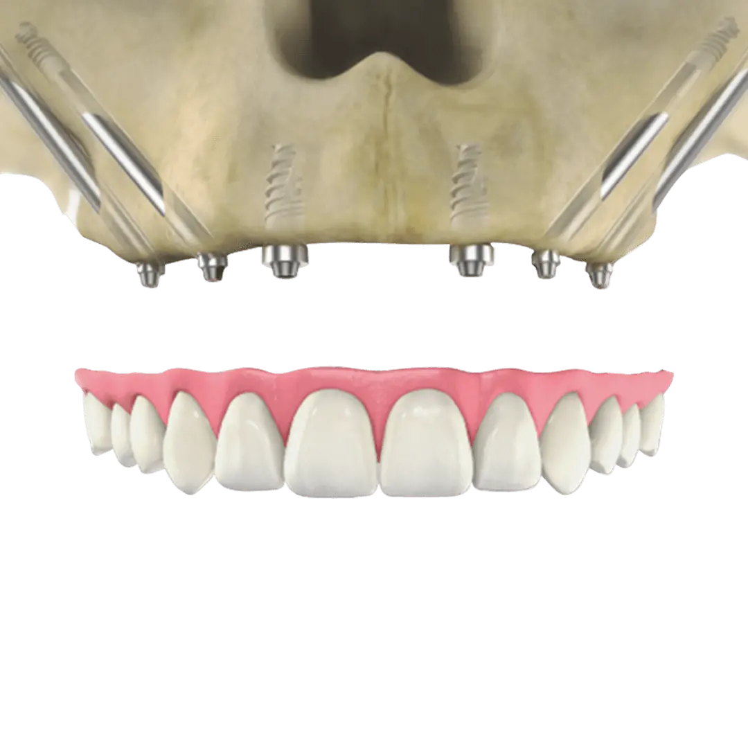 Advantages of Zygomatic Implants