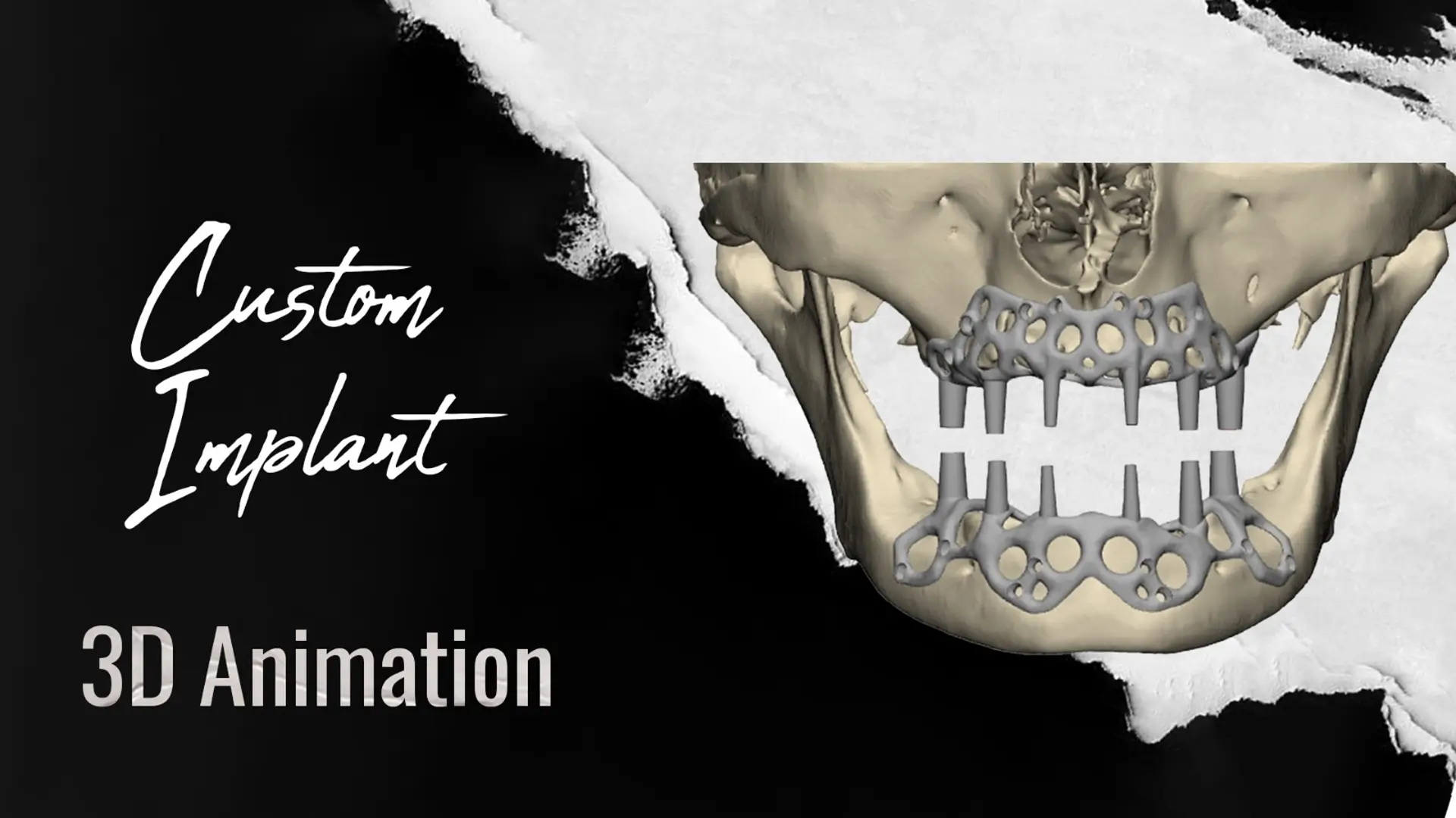 Custom-Dental-Implants-in-Istanbul-Turkey