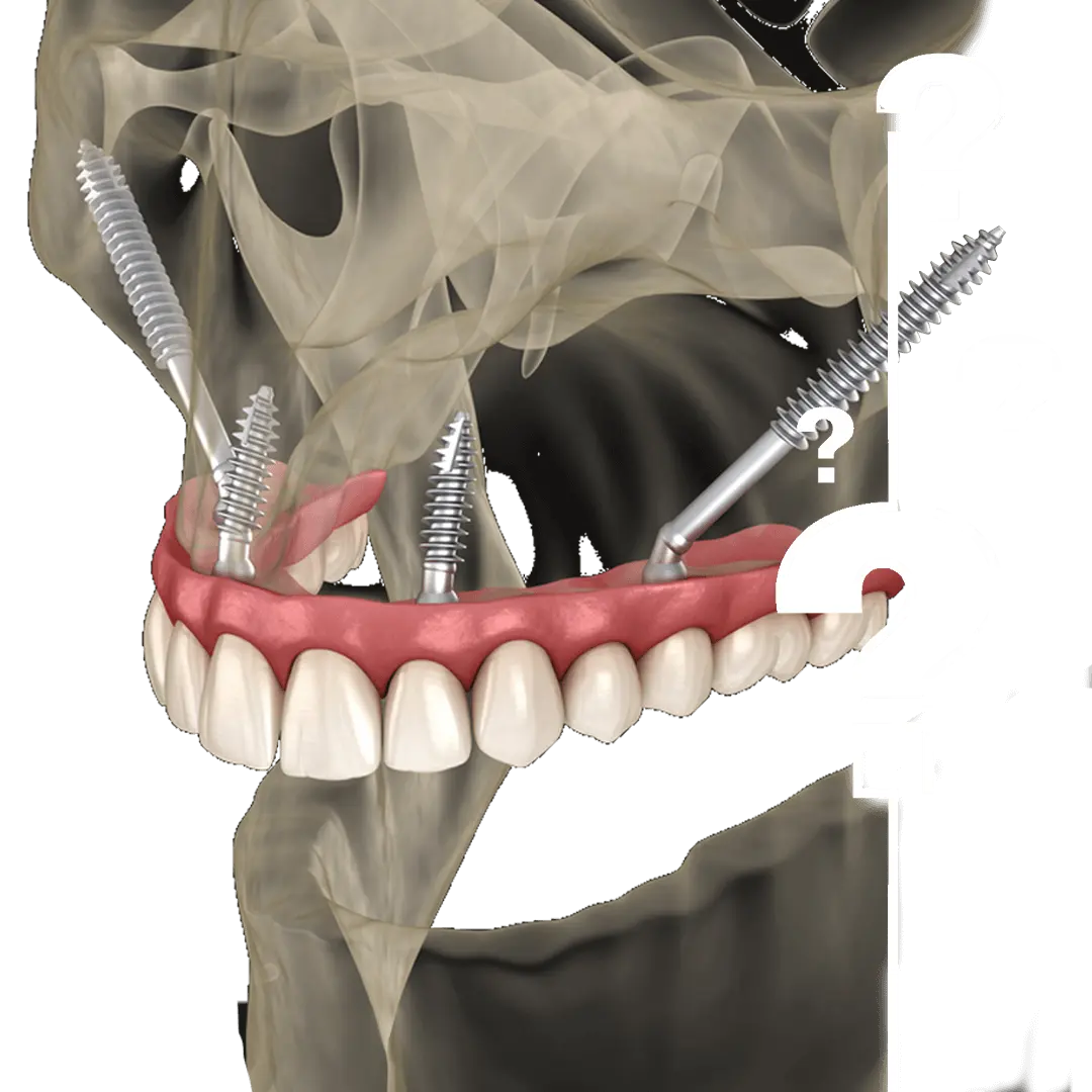 How Much Do Zygomatic Implants Cost