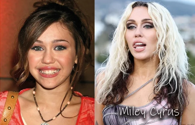 Miley Cyrus Teeth Before and After