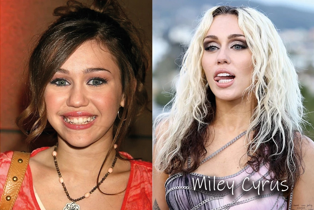 Miley Cyrus Teeth Before and After