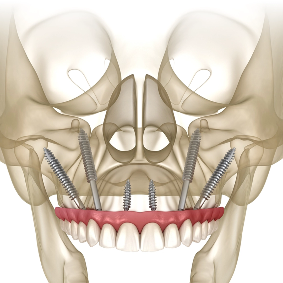 What Are Zygomatic Implants