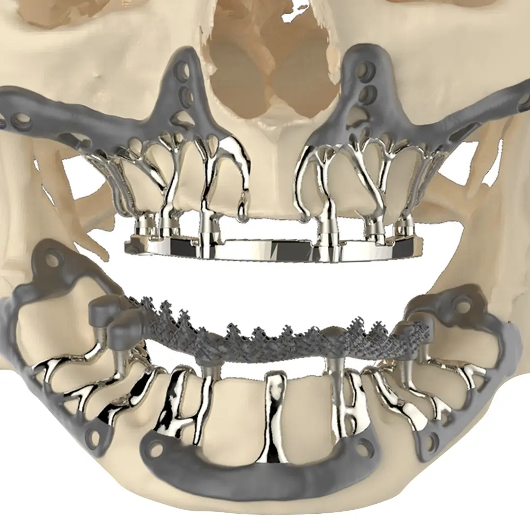 What Is Custom Dental Implants