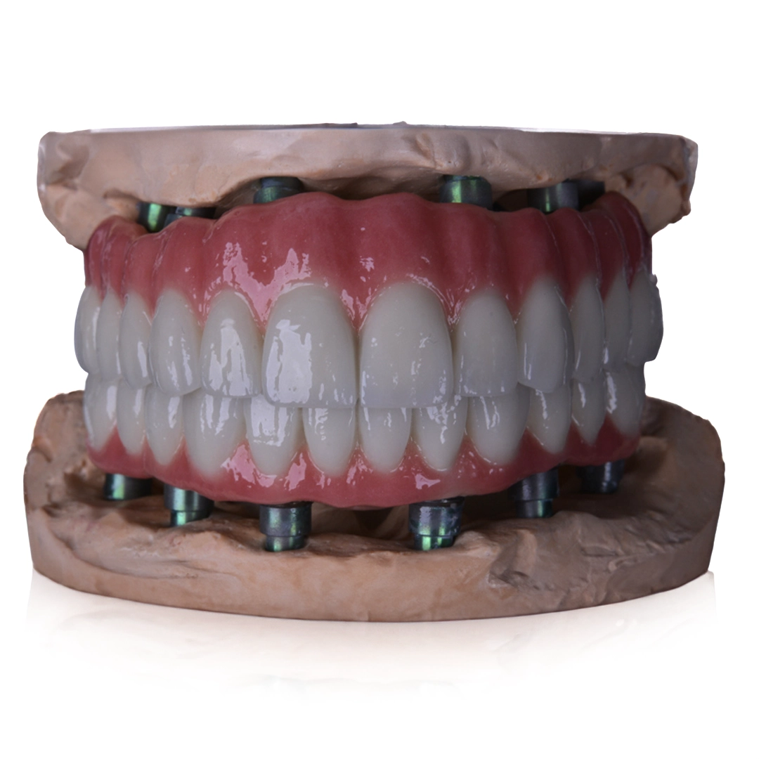 What Is Toronto Dental Bridge 