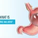 What is the Gastric Balloon