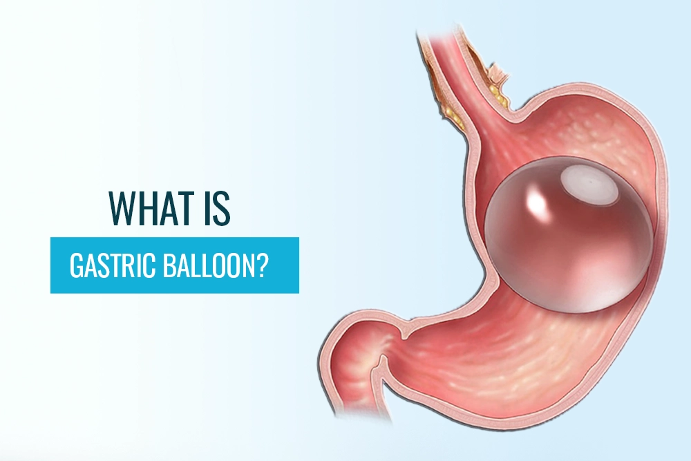 What is the Gastric Balloon