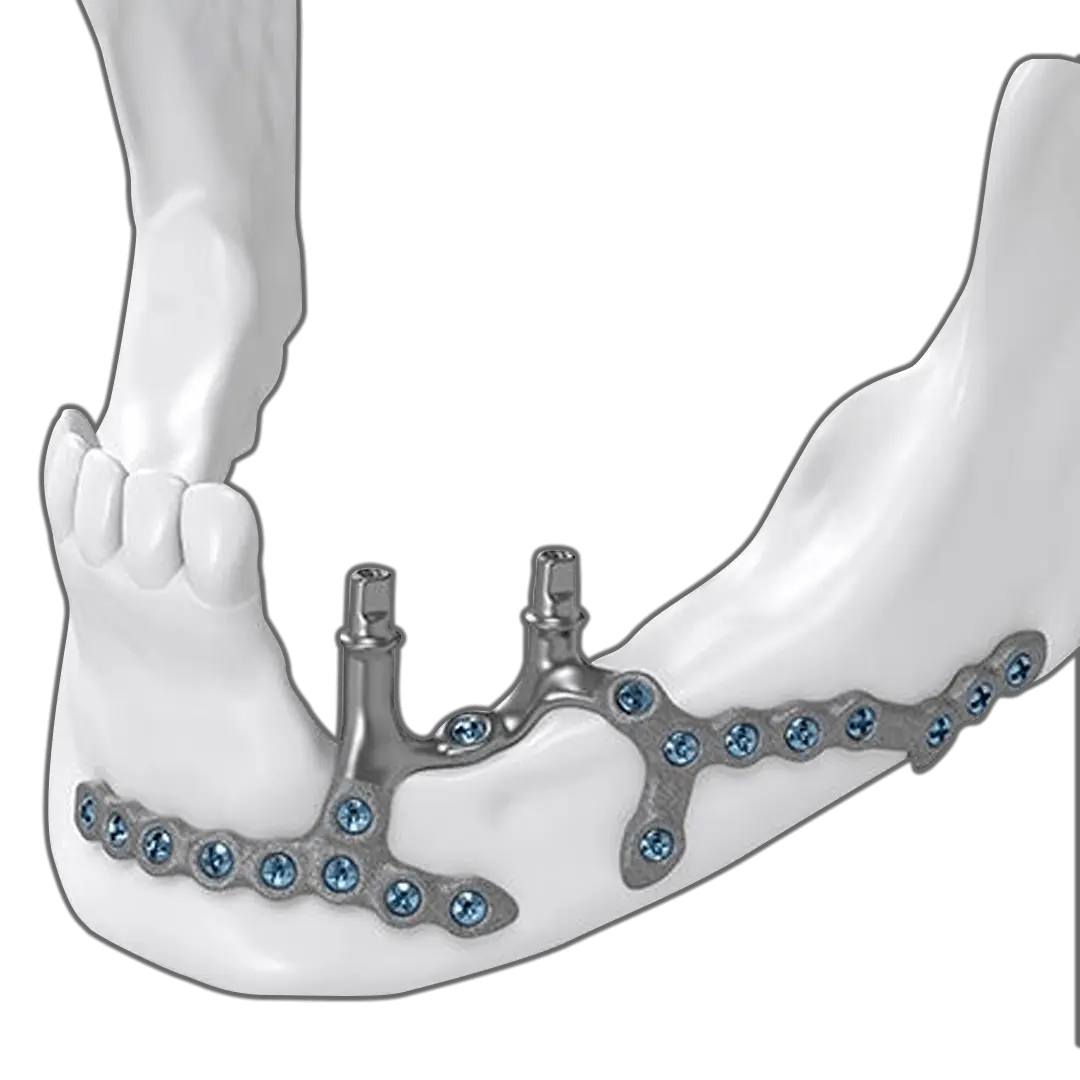 Why Choose Us for Custom Implants in Istanbul