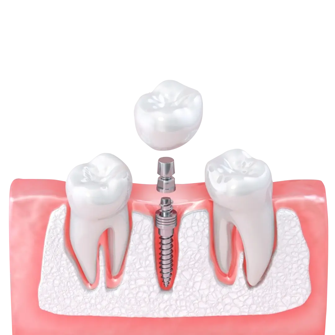 Advantages of Mini Dental Implants