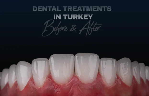 Dental Treatments in Turkey: Teeth Before and After Photos