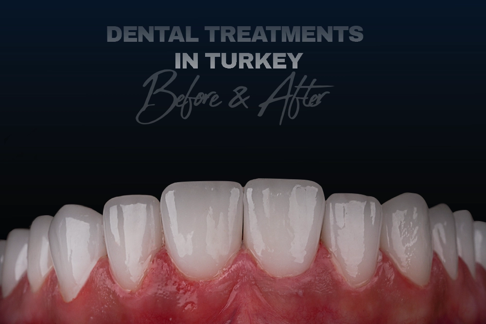 Dental Treatments in Turkey: Teeth Before and After Photos