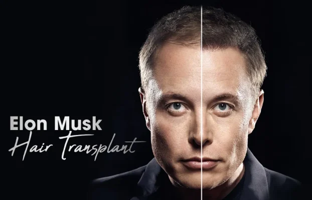 Elon Musk Hair Transplant