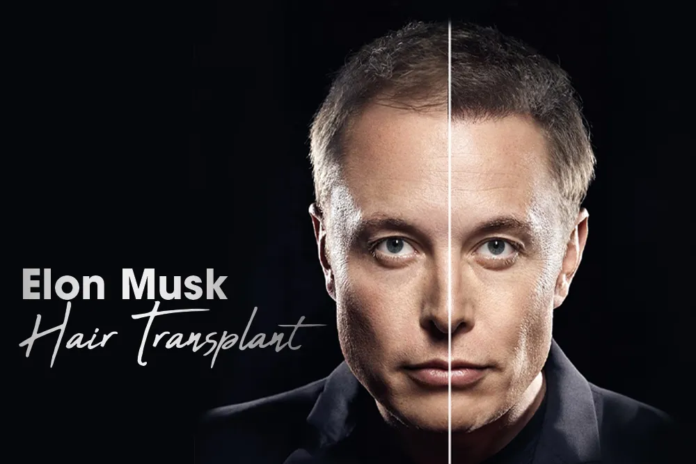 Elon Musk Hair Transplant