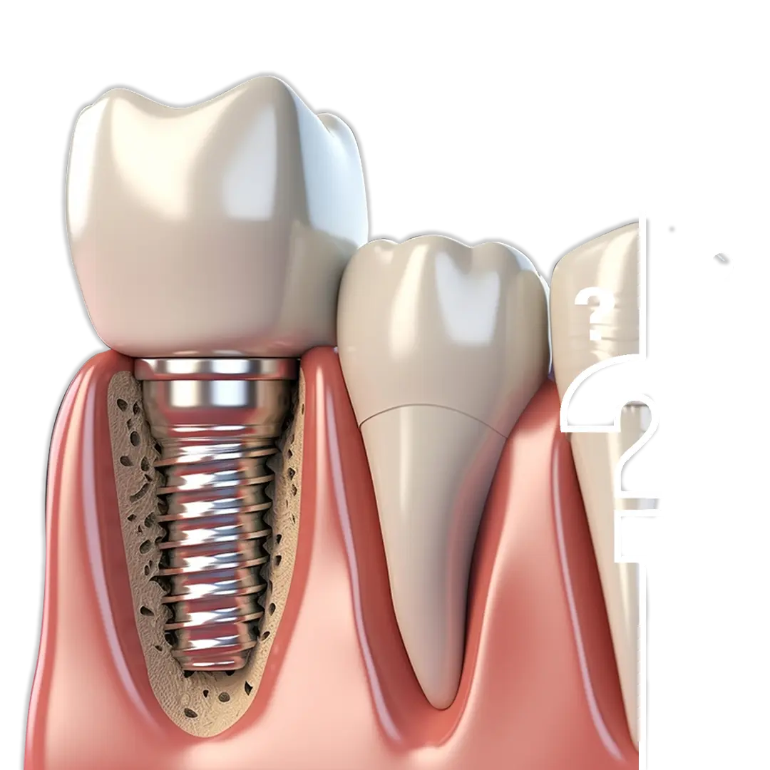 How Much Do Mini Implants Cost in Istanbul