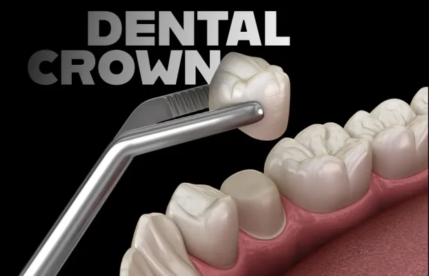 How Much Does a Dental Crown Cost in Turkey?