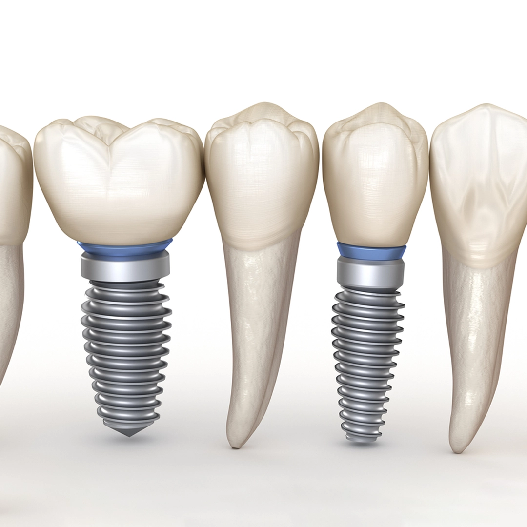 What Are Mini Dental Implants