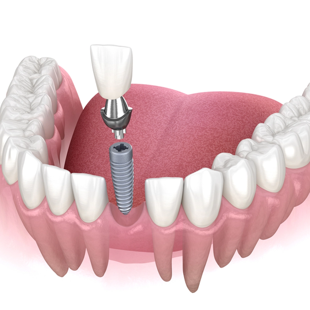 Who-Qualifies-for-Mini-Dental-Implants