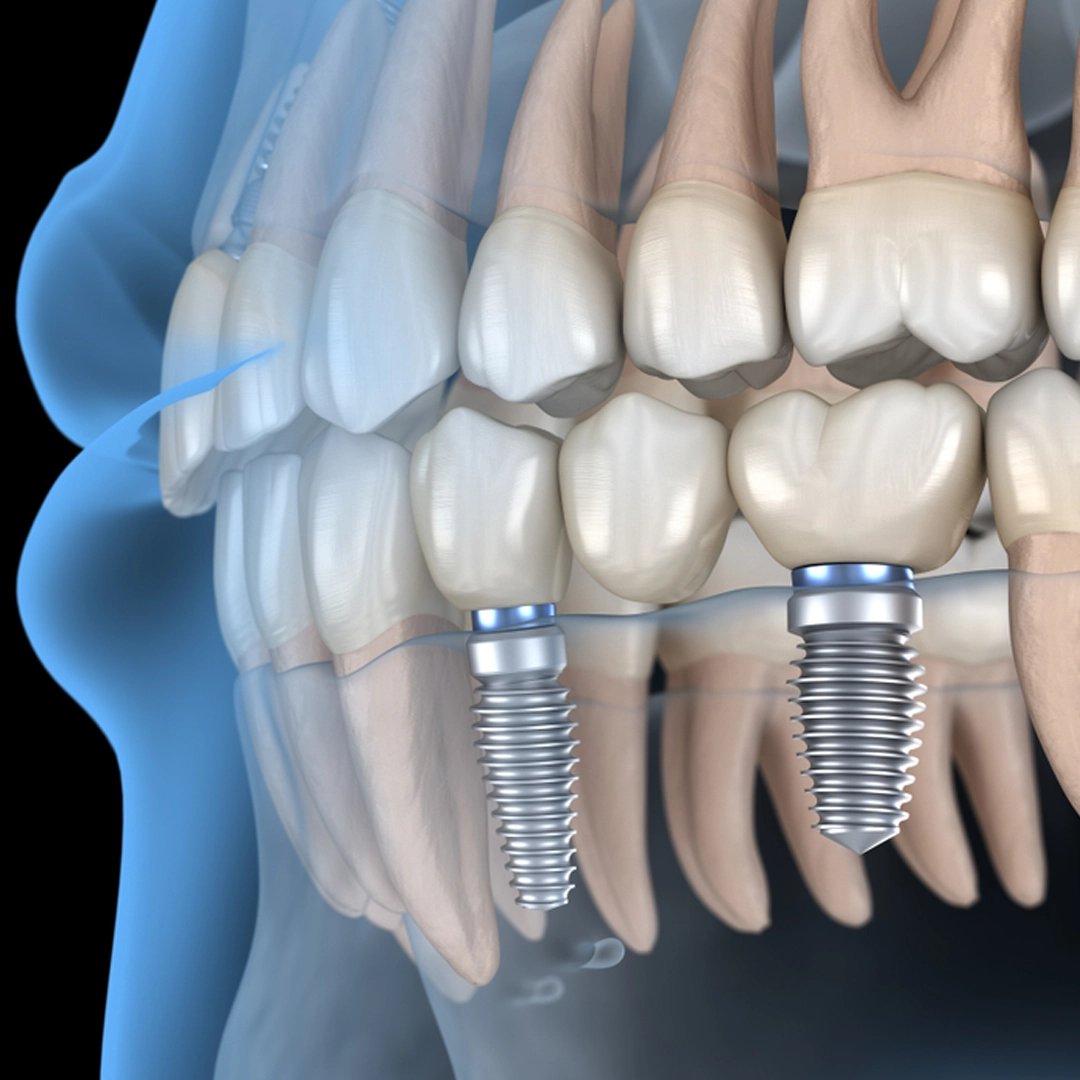 Why Choose Us for Mini Implants in Istanbul, Turkey