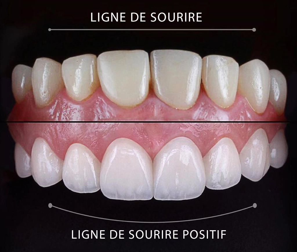 Avantages de Hollywood Smile