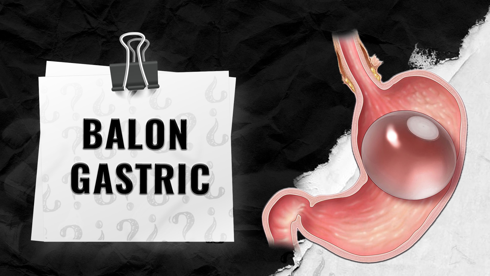 Balon-gastric-in-Istanbul-Turcia