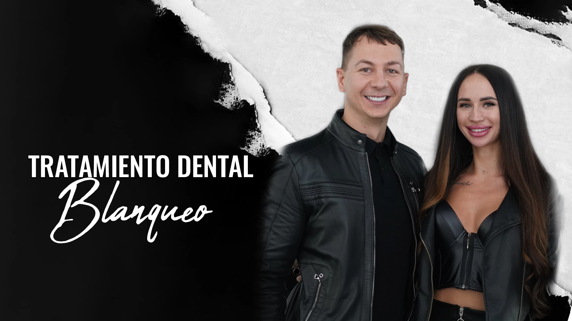 Blanqueamiento-dental-en-Estambul-Turquia