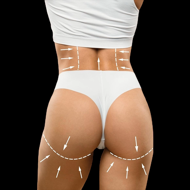 Бразилско повдигане на дупето (BBL) (преди след)