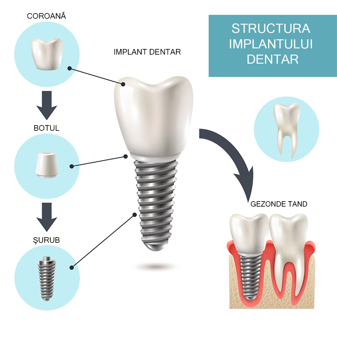 Ce sunt implanturile dentare