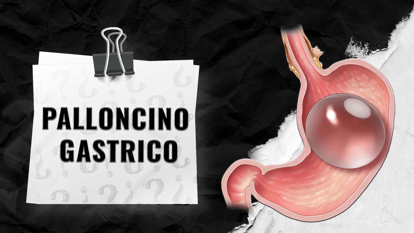 Chi-si-qualifica-per-il-palloncino-gastrico