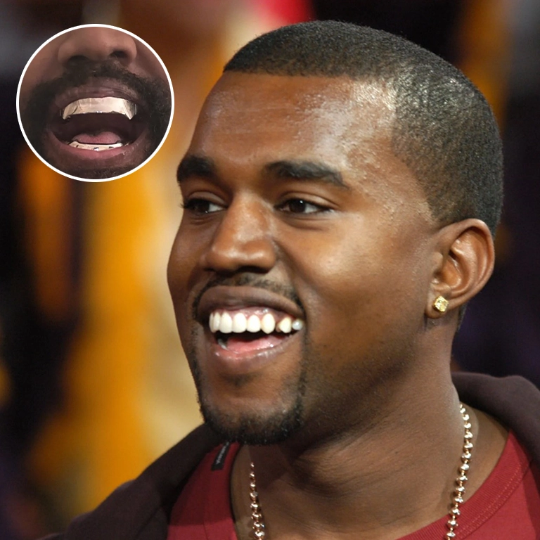 Kanye West Dental Aesthetics