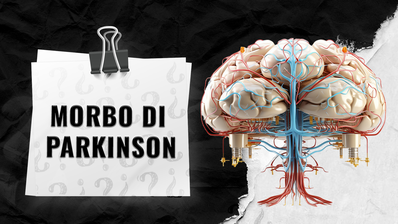 Morbo-di-Parkinson