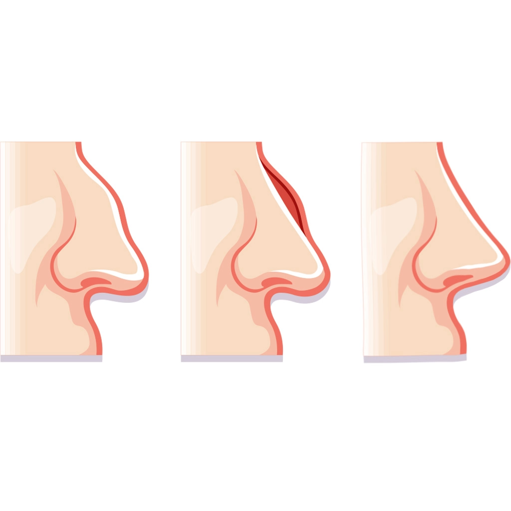 Qu’est ce que la rhinoplastie