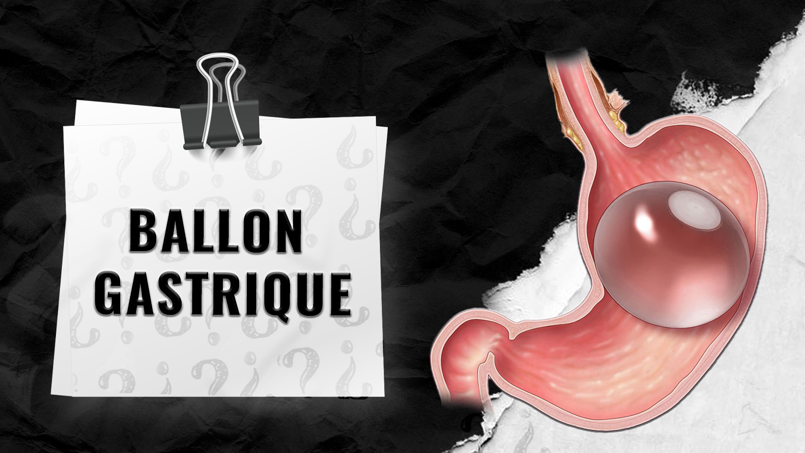 Qui-est-admissible-au-ballon-gastrique-_