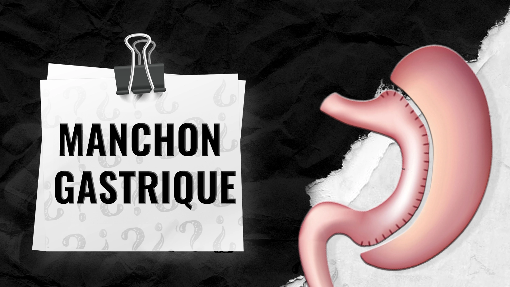 Qui-est-eligible-pour-la-sleeve-gastrique