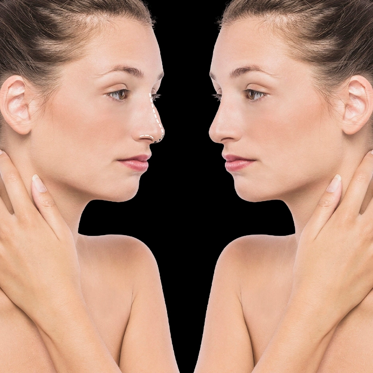 Ринопластика (преди след)