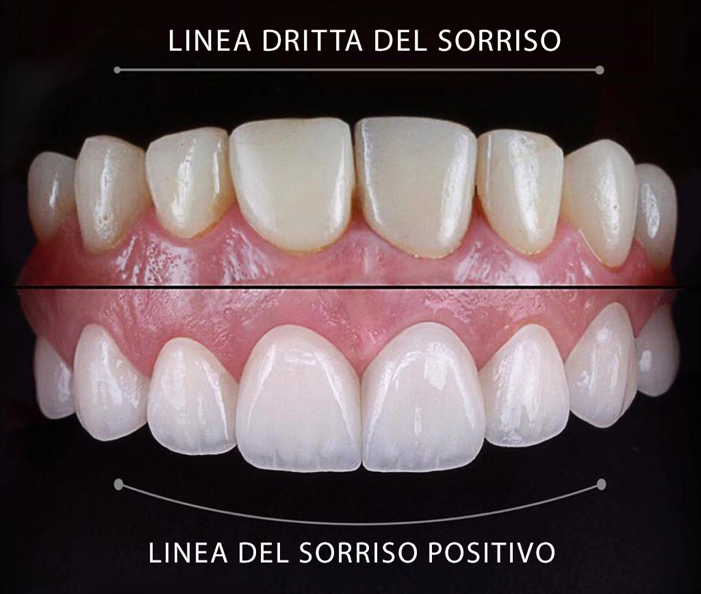 Vantaggi di Hollywood Smile