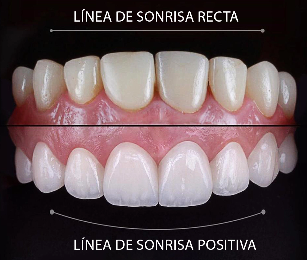 Ventajas de Hollywood Smile