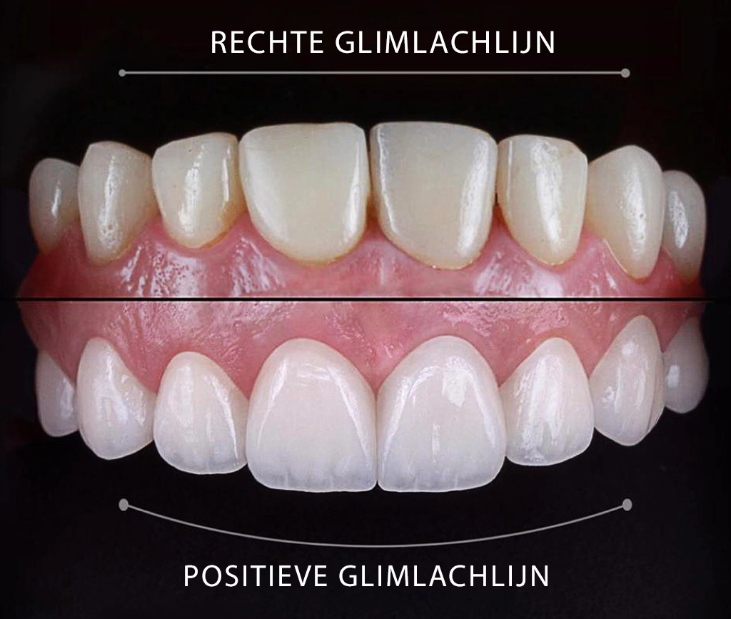 Voordelen van Hollywood Smile