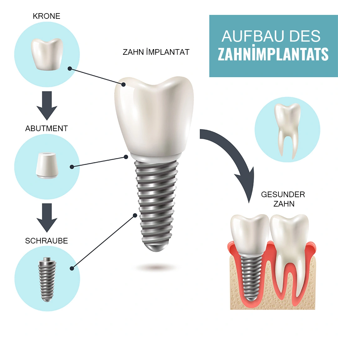 Was sind Zahnimplantate