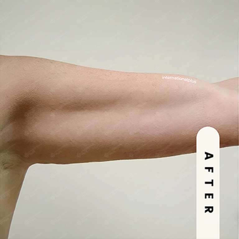 arm lift before after 12